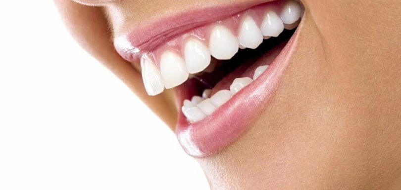 Bogazici Dis Polikinligi Dis Beyazlatma Resim 5