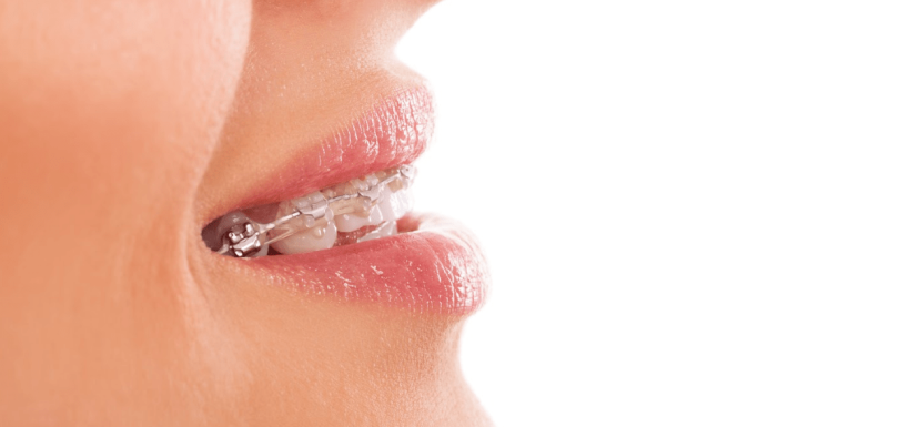 Çarpık Diş Tedavisi