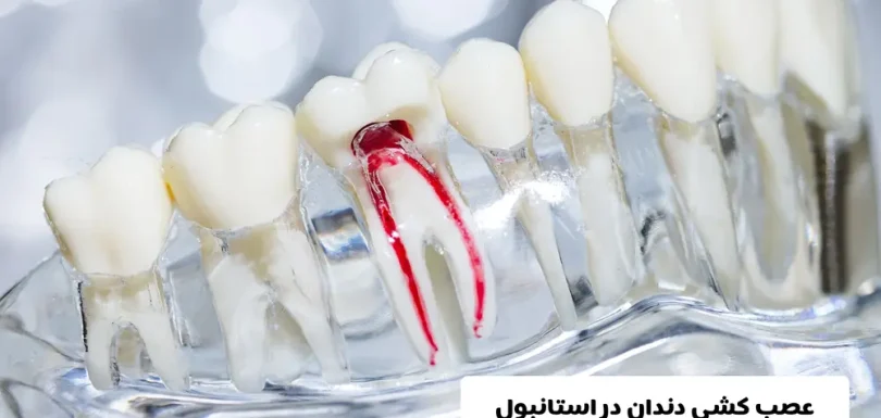 عصب کشی دندان در استانبول