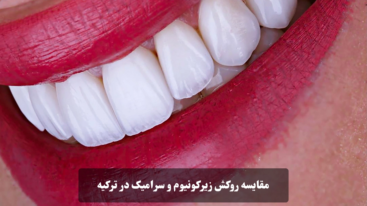 مقایسه روکش زیرکونیوم و سرامیک در ترکیه