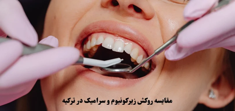 مقایسه روکش زیرکونیوم و سرامیک در ترکیه